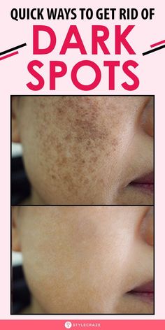 Brown Spots Removal, Brown Spots On Face, Skin Spots, Spots On Face