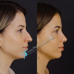 Rhinoplasty Gallery | Assoc. Prof. Dr. Suleyman TAS Nose Job Inspiration, Desired Nose, Nose Plastic Surgery, Face Plastic Surgery, Nose Fillers, Rhinoplasty Before And After