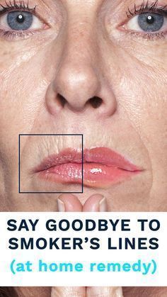 Smokers Lines, Wrinkle Remedies, Lip Wrinkles, Forehead Wrinkles, Skin Care Wrinkles, Glow Skin, Saggy Skin, Face Wrinkles, Deep Skin