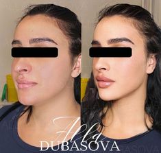 Aesthetic Procedures, Skin Care Procedures, Lips Inspiration, Botox Lips, Facial Structure, Ash Brown Hair Color, Beauty Procedures, Fat Grafting, Skin Care Business