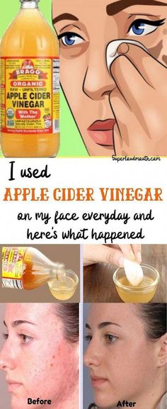 Apple cider vinegar is a wonder tonic which has ample beauty benefits. This includes all the skin-related issues such as acne, dark spots, sunburns, pigmentation, dry skin, oily skin and many more. It is actually made by fermenting apple juice with bacteria and yeast to obtain alcohol. In the second fermentation step, by adding yeast