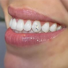 a woman's smile with white teeth and clear gums