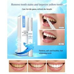 This Teeth Whitening Pen is a powerful tooth whitening tool that can have your teeth bright and gleaming in just seconds. Clean Away Years Of Stains and Stubborn Plaque Quickly & Easily. The formula is tough on stains while being 100% safe and gentle to the rest of your mouth so you don't need to worry about any sensitivity during or after the treatment. Features & Benefits: STUNNING SMILE - You can look forward to a dazzling bright white smile that leave you radiant and confident FAST RESULTS - Teeth Whitening Pen is effective, you will be able to clean away year of stains, discoloration and plaque in just a few seconds EASY APPLICATION - No more trays and complicated light systems, just apply whenever you want for a fabulously white smile that will have heads turning LONG LASTING BRIGHTN Home Teeth Whitening, Teeth Whitening Methods, Tooth Gel, Brighten Teeth, Teeth Whitening Gel, Perfect Teeth, Teeth Whitening Pen, Yellow Teeth, Stronger Teeth