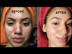 Best Acne Scar Removal, Face Mask For Pimples, Redness Pimple, Painful Acne, Pimple Free Skin, Teenage Acne, Forehead Acne, Pimples Remedies, Pimples On Face