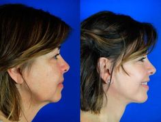 Platysma Muscle, Deep Plane Facelift, Face Treatments, Laser Skin Resurfacing, Face Ideas, Beauty Procedures, Neck Surgery