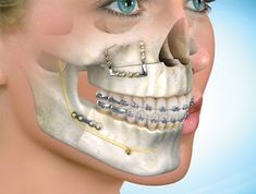 Surgeon Humor, Corrective Jaw Surgery, Surgery Humor, Orthognathic Surgery, Dentist Day, Face Surgery, Jaw Surgery, Dental Surgeon