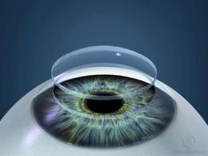 Corneas are the only tissues that don't require blood. One of the reasons why cornea surgery is at or about 100% successful. Corneal Transplant, Laser Eye Surgery, Lasik Surgery, Laser Eye, Type Treatments, Eye Surgery