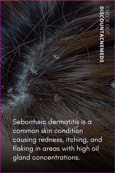 Discover effective tips and remedies for treating seborrheic dermatitis, a common skin condition characterized by red, itchy, and flaky skin. Find relief and manage symptoms with these proven treatment methods. Learn more with Discountacnemeds #seborrheic #itchy #flakyskin #skin #treatment Skincare For Oily Skin, Essential Oils For Skin, Clear Skin Tips, Skin Condition, Flaky Skin, Skin Issues, Blackhead Remover, Reduce Wrinkles