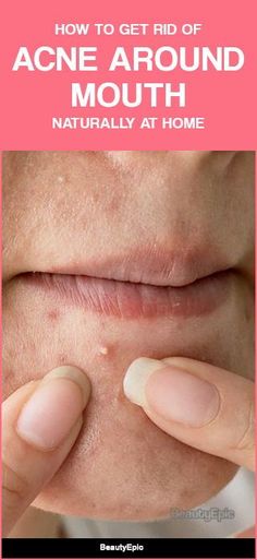 How To Get Rid Of Acne Around Mouth? Acne Around Mouth, Forehead Acne, Prevent Pimples, Get Rid Of Acne, Rid Of Acne, Fall Makeup Looks, Acne Breakout