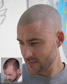 Hair Tattoo Men, Shaved Head Styles, Balding Mens Hairstyles, Rancho Cucamonga California, Bald Men Style, Bald Look, Scalp Micropigmentation, Loss Hair, Hair Transplant Surgery