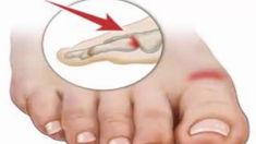 HOW TO QUICKLY REMOVE URIC ACID CRYSTALLIZATION FROM YOUR BODY TO PREVENT GOUT AND JOINT PAIN!!If you found this video valuable, give it a like.If you know s... Foot Pain Chart, Types Of Bones, Uric Acid, Joints Pain Relief, Foot Pain, Red