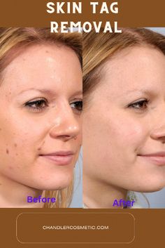 If you have a skin tag near eyes or face. Dr. Chandler is the top rated skin tag removal surgeon in Philadelphia. Contact us free consultation. What Are Skin Tags, Surgical Scissors, Home Remedies For Skin, Liquid Nitrogen, Working Mom Tips, Excess Skin