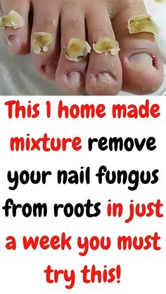 This 1 homemade mixture remove your nail fungus from roots in just a week you must try this to Kill Toenail Fungus Naturally instantly Foot Fungus Soak, Homemade Nail Polish, Fungal Infection