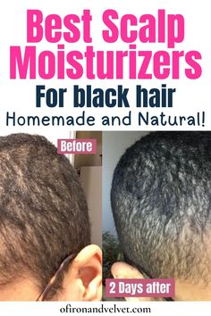 The 4 Best scalp moisturizers for black hair: Easy, cheap and home-made - Of Iron and Velvet Dry Hair Remedies For Black Women, Good Moisturizer For Natural Black Hair, Alopecia Hairstyles Black Women, Scalp Spa, Black Hair Growth, Hair Detox, Natural Hair Moisturizer