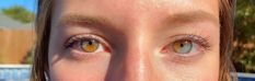 Partial Heterochromia, Cat Eye Syndrome, Sectoral Heterochromia, Heterochromia Eyes, Visible Veins, Beautiful Eyes Color, Different Colored Eyes, Baby Teeth, Pretty Eyes