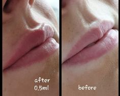 Lip Filler 5ml, .5ml Lip Filler, Lip Filler Inspo 0.5ml, Lip Fillers Inspiration, Top Lip Filler