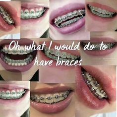 Braces Journey, Red Braces, Cute Promise Rings, Braces Colors