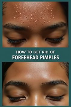 Struggling with forehead acne? Say goodbye to breakouts with these 9 easy home remedies! From tea tree oil to aloe vera, these natural solutions will help you achieve clear, glowing skin without harsh chemicals. Perfect for anyone looking for affordable, effective skincare tips! 💧✨  👉 Save this pin for your ultimate guide to fighting acne naturally!