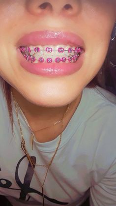 Dental Braces Colors, Braces Colors Combinations, Braces For Teeth, Pink Braces, Green Braces, Jewelry Teeth, Braces Colors Ideas, Braces Bands, Teeth Gems