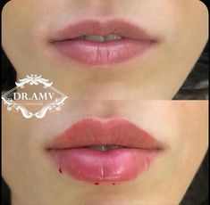 Natural Lip Plumper, Rhinoplasty Nose Jobs, Face Fillers