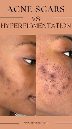 Know how you feel when dinner guests overstay their welcome? Well, that’s exactly what it’s like when acne and hyperpigmentation flare up. These are two skincare terms that everyone wants to avoid as the marks can stay on for ever. Skincare Terms, Pigmentation Remedy, Skin Care Hyperpigmentation, Melanin Skin