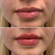 Face Atonomy, Lip Injections Juvederm, Brow Lifting, Facial Procedure, Face Fillers, Plum Lips