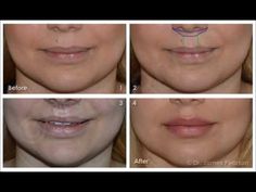 Botox Before And After, Laser Teeth Whitening