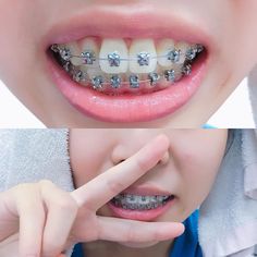 Adult Braces, Orthodontic Appliances