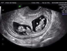 Ultrasound Prank, Fake Ultrasound, 4 Weeks Pregnant, 9 Weeks Pregnant, Fake Pregnancy, Twin Baby Boys, Baby Ultrasound, Ultrasound Pictures, Identical Twins