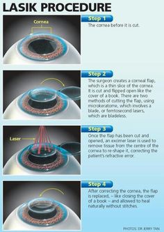 Lasik Opthalmic Technician