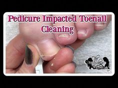 This video is about How to Pedicure Clean Impacted Toenails. In todays video your going to see the tedious removal of the start of an ingrown toenail on the ... Pedicure Tutorial, Toenail Removal, Acrylic Nails At Home, Ingrown Toenail, Acrylic Nail Shapes, Nails Today, Ingrown Toe Nail, Pedicure Kit