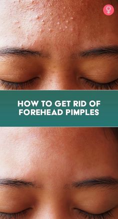 How To Get Rid Of Redness On Face With 1 Product | Skin Care Tips Forehead Pimples, Get Rid Of Forehead Acne, Forehead Bumps, Pimples On Forehead, Forehead Acne, Bad Acne, Acne Overnight