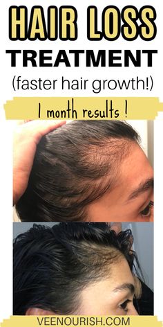 Want to learn how to stop hairfall? If so, take a look at the best hair loss treatment for women and men. Learn how to stop hair from falling out with these hair loss remedies that are 100% natural. It will treat hormonal hair loss, postpartum hair loss and hair loss due to stress. How To Stop Hairfall, Stop Hairfall, Grow Thick Long Hair, Postpartum Hair, Hair Growth Formula, Loss Hair, Hair Thinning, New Hair Growth