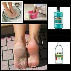 Foot Soak! 1/4 cup listerine, 1/4 cup vinegar and 2 cups warm water. Let feet soak for 10 min then rinse. Rub feet well with a towel removing excess skin. Then moisturize. Heal Cracked Heels, Foot Soak Recipe, Antiseptic Mouthwash, Bolesti Chrbta, Foot Soak, Beauty Remedies, Mouthwash, Health And Beauty Tips, Cleaning Products