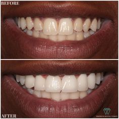 Porcelain Crowns in Turkey. Get free quote for your dental treatment in Turkey and save 70%. Porcelain Crowns, Tooth Crown, Front Teeth, Teeth Whitening Pen, Dental Veneers, Dental Center, Dental Crowns, Smile Makeover