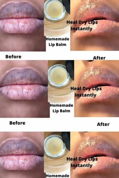 Homemade Lip Balm for Chapped Dry Lips||How to Get Rid of Very Dry LipsDIY Lip BalmHomemade Lip Balm Hello beautiful people! you're welcome back to my Channe... Brighten Lips Diy, Chapped Lips Remedy Severe, Remedies For Dry Mouth, Very Dry Lips, Home Remedies For Allergies, Home Remedies For Warts, Warts Remedy, Natural Remedies For Migraines