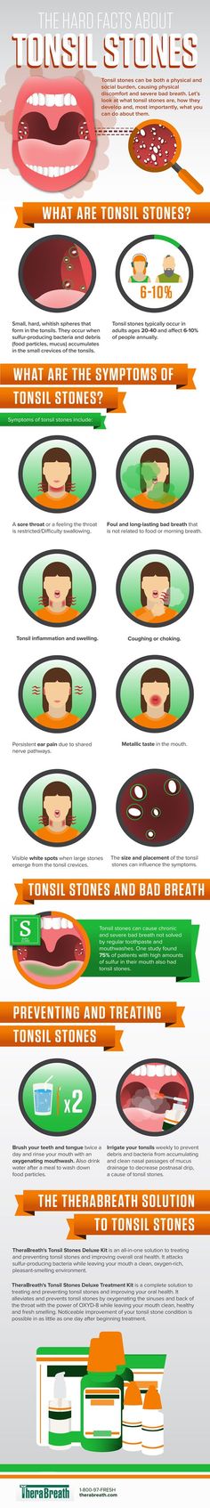 The Hard Facts About Tonsil Stones #Infographic #Health Tonsil Stone Remedies, Tonsil Stone, Straighten Teeth, Mouth Wash, Health Infographics, Banana Benefits, Nutrition Quotes, Calendula Benefits, Sport Nutrition