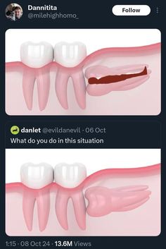 two screens showing different stages of tooth decay, one with gums and the other without teeth