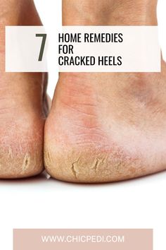 7 Home Remedies for Cracked Heels That Make a Difference. Try Our Cracked Heels Solutions For Healthier Looking Feet. Heel Care, Thick Moisturizer, Heel Pain Relief