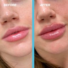 before and after photos of a woman's lips with lip fillers on her cheeks