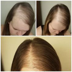 In today’s article, deborahholt582.blogspot.com presents relevant information about haircut for lady with female pattern baldness. We’ve made this article with the hope that you’ll find it valuable for your needs regarding haircut for lady with female pattern baldness.. #haircut #for #lady #with #female #pattern #baldness Male Pattern Baldness Hairstyles, Hairstyles For Female, Hairstyles For Hair, Balding Men, Hairstyles Female, Natural Hair Regrowth, Hair Fall Solution, Female Pattern Baldness, Pattern Hair