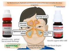 Sinus infection makes a flower petal like spread around the base of the nose covering the 4 sinus regions around it. This causes frontal headache, pain in teeth, nose blockage and post nasal drop that lands in throat. Homeopathy for #sinusitis, know more Homeopathy For Sinus Infection, Sinusitis Symptoms, Sinus Headache Remedies, Alternative Medicine Holistic Healing, Remedy For Sinus Congestion, Sinus Allergies, Homeopathy Remedies