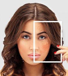 There are many ways to treat skin pigmentation. But not everyone knows about these methods. Click here for some of the best home remedies for skin pigmentation. Pigmentation Remedy, Dark Patches On Skin, Home Remedies For Skin, Treating Hyperpigmentation, Skin Pigmentation, Skin Spots, Skin Blemishes, Beauty Remedies