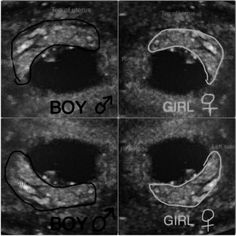 four different images of the same person's breast, with their names in black and white