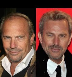 Celebrity Hair, Bald Men, Kevin Costner, Medical Aesthetic, Hair Replacement, Hair Regrowth, Hair Restoration, Hair Transplant, Hair Photo