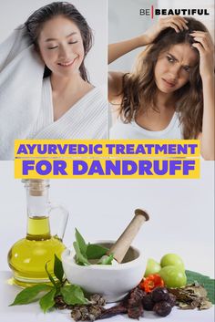 Ayurvedic treatment for dandruff What Is Dandruff, Natural Dandruff Remedy, Diy Haircare, Lemon Balm Extract, Work Hair, Ayurvedic Oil