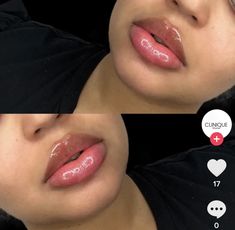 Different Lip Shapes Fillers, Round Lip Filler Shape, Lips Fillers Shapes, Thick Lips Aesthetic, Lip Filler Black Women, Lip Filler Before And After, 1ml Lip Filler, Cupids Bow Lips, Lip Job