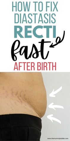 After Birth Exercises, Correcting Diastasis Recti, How To Fix Diastasis Recti Years Later, Healing Diastasis Recti Years Later, After C Section Workout