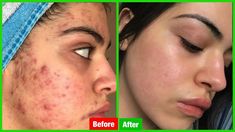 How to Remove Pimples Overnight | Acne Treatment - Best Home Remedy#howtoremovepimples #acnetreatment #pimples #acnemask #acne #postacne Remove Pimples Overnight, To Remove Pimples, Get Rid Of Pimples, Rid Of Pimples, Remove Pimples, Essential Oils For Pregnancy, Improve Nutrition