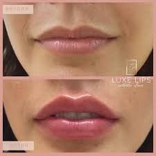 Lip Tint Tattoo, Micropigmentation Lips, Lip Filler Inspiration, Lip Color Tattoo, Botox Training